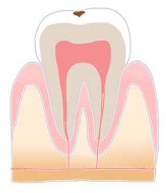 船堀の歯医者で虫歯治療