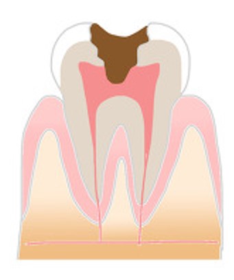 船堀の歯医者で虫歯治療